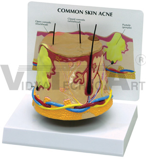 Skin Acne